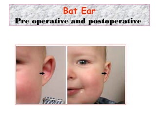Bat Ear
Pre operative and postoperative
 