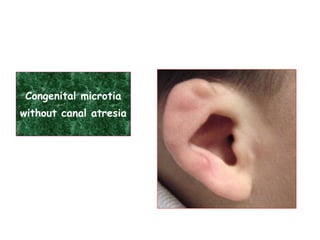 Congenital microtia
without canal atresia
 