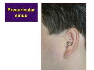 Preauricular
sinus
 