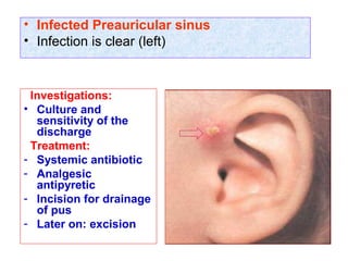 • Infected Preauricular sinus
• Infection is clear (left)
Investigations:
• Culture and
sensitivity of the
discharge
Treatment:
- Systemic antibiotic
- Analgesic
antipyretic
- Incision for drainage
of pus
- Later on: excision
 