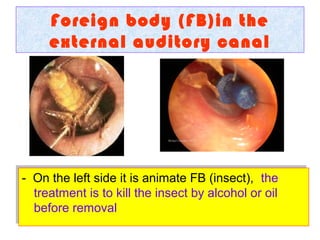 Foreign body (FB)in the
external auditory canal
- On the left side it is animate FB (insect), the
treatment is to kill the insect by alcohol or oil
before removal
- On the left side it is animate FB (insect), the
treatment is to kill the insect by alcohol or oil
before removal
 