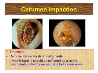 Cerumen impaction
• Treatment
- Removal by ear wash or instruments
- If wax is hard, it should be softened by glycrine
bicarbonate or hydrogen peroxide before ear wash
 