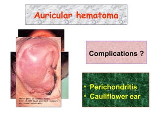 Complications ?
• Perichondritis
• Cauliflower ear
Auricular hematoma
 