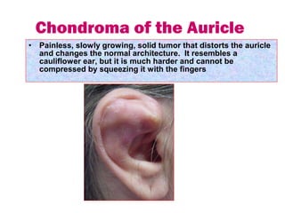 • Painless, slowly growing, solid tumor that distorts the auricle
and changes the normal architecture. It resembles a
cauliflower ear, but it is much harder and cannot be
compressed by squeezing it with the fingers
Chondroma of the Auricle
 