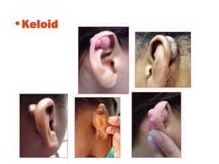 •Keloid
 