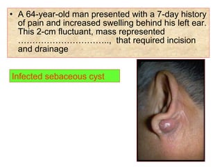 • A 64-year-old man presented with a 7-day history
of pain and increased swelling behind his left ear.
This 2-cm fluctuant, mass represented
………………………….., that required incision
and drainage
Infected sebaceous cyst
 