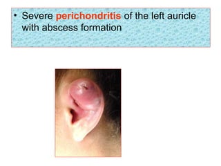 • Severe perichondritis of the left auricle
with abscess formation
 