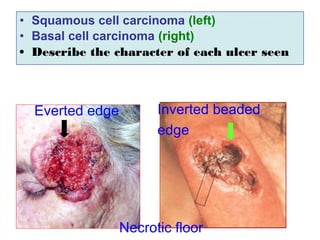 • Squamous cell carcinoma (left)
• Basal cell carcinoma (right)
• Describe the character of each ulcer seen
Everted edge Inverted beaded
edge
Necrotic floor
 