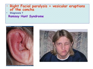 • Right Facial paralysis + vesicular eruptions
of the concha
• Diagnosis ?
Ramsay Hunt Syndrome
 