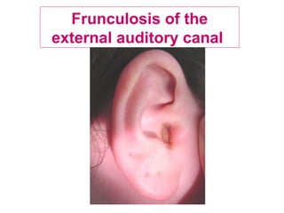 Frunculosis of the
external auditory canal
 