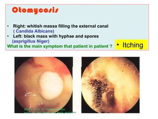Otomycosis
• Right: whitish massa filling the external canal
( Candida Albicans)
• Left: black mass with hyphae and spores
(asprigillus Niger)
What is the main symptom that patient in patient ? • Itching
 