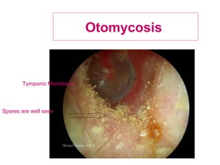 Otomycosis
Tympanic Membrane
Spores are well seen
 