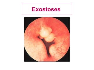 Exostoses
 