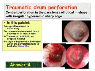 Traumatic drum perforation
Central perforation in the pars tensa elliptical in shape
with irregular hyperaemic sharp edge
• In this pateint:
1-surgical treatment is
mandatory
2- conservative treatment is not
successful in most cases
3- The use of antibiotic ear
drops is helpful
4- surgical treatment is indicated
when the perforation fails to
heal after 3 months
Answer: 4
 