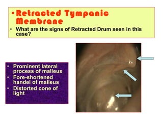 •Retracted Tympanic
Membrane
• What are the signs of Retracted Drum seen in this
case?
• Prominent lateral
process of malleus
• Fore-shortened
handel of malleus
• Distorted cone of
light
 
