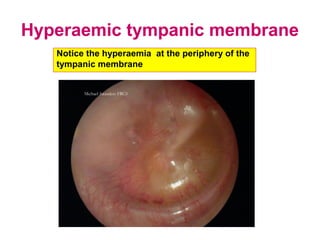 Hyperaemic tympanic membrane
Notice the hyperaemia at the periphery of the
tympanic membrane
 