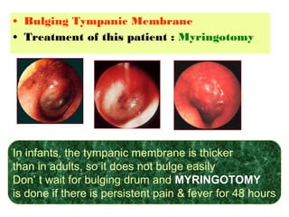 • Bulging Tympanic Membrane
• Treatment of this patient : Myringotomy
In infants, the tympanic membrane is thicker
than in adults, so it does not bulge easily
Don’ t wait for bulging drum and MYRINGOTOMY
is done if there is persistent pain & fever for 48 hours
 
