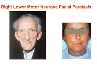 Right Lower Motor Neurone Facial Paralysis
 