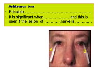 Schirmer test
• Principle:…………………………………………….
• It is significant when…………………and this is
seen if the lesion of ………….nerve is ………….
A B
 