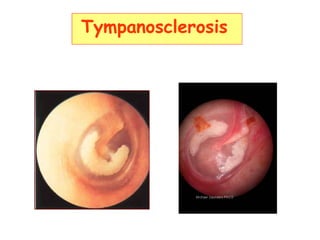Tympanosclerosis
 