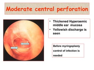 Moderate central perforation
• Thickened Hyperaemic
middle ear mucosa
• Yellowish discharge is
seen
Before myringoplasty
control of infection is
needed
 