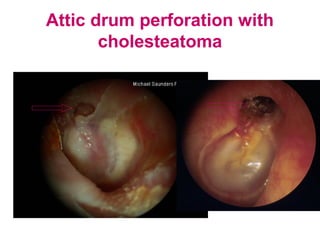 Attic drum perforation with
cholesteatoma
 