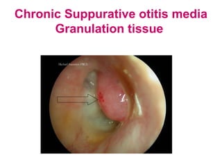 Chronic Suppurative otitis media
Granulation tissue
 