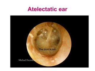 Atelectatic ear
The drum is thin
 