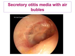 Secretory otitis media with air
bubles
 