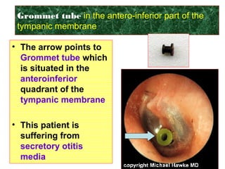 Grommet tube in the antero-inferior part of the
tympanic membrane
• The arrow points to
………….. which is
situated in
the…………quadrant
of the ………..
• This patient is
suffering from
………….
• The arrow points to
Grommet tube which
is situated in the
anteroinferior
quadrant of the
tympanic membrane
• This patient is
suffering from
secretory otitis
media
 