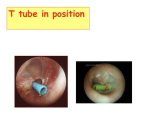 T tube in position
 