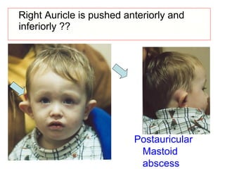 Right Auricle is pushed anteriorly and
inferiorly ??
Postauricular
Mastoid
abscess
 