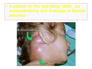 • A patient on the operating table for
mastoidectomy and drainage of Bezold
abscess
 