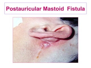 Postauricular Mastoid Fistula
 
