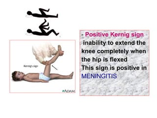 - Positive Kernig sign
inability to extend the
knee completely when
the hip is flexed
This sign is positive in
MENINGITIS
 