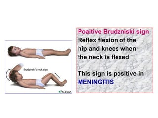 Poaitive Brudzniski sign
Reflex flexion of the
hip and knees when
the neck is flexed
This sign is positive in
MENINGITIS
 