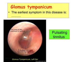 Glomus tympanicum
• The earliest symptom in this disease is:
………
Pulsating
tinnitus
 
