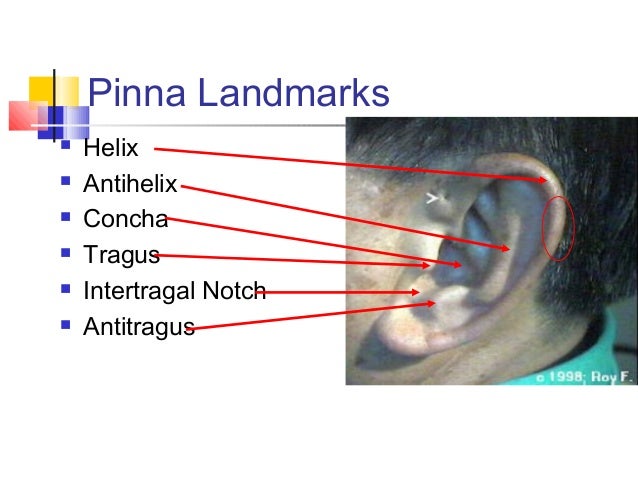 Intertragal Notch Ear Pain : Symptoms, Causes, Treatments for Pain ...