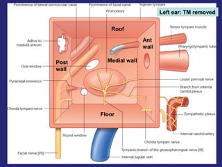 31
Left ear: TM removed
Roof
Floor
Medial wall
Ant
wall
Post
wall
 