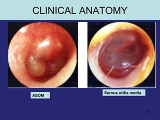 51
Serous otitis media
ASOM
CLINICAL ANATOMY
 