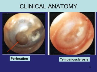 52
Perforation Tympanosclerosis
CLINICAL ANATOMY
 