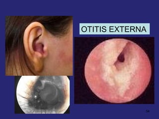 54
OTITIS EXTERNA
 