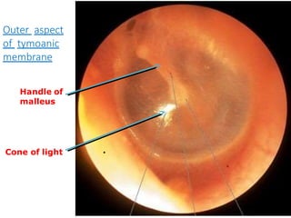 Outer aspect
of tymoanic
membrane
Handle of
malleus
Cone of light .
 