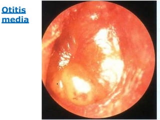 Otitis
media
.
 