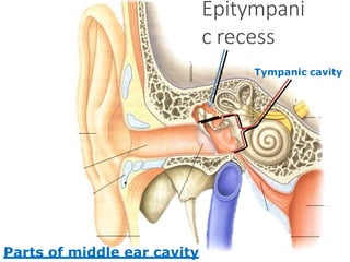Epitympani
c recess
Tympanic cavity
Parts of middle ear cavity
.
 