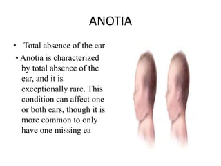 ANOTIA
• Total absence of the ear
• Anotia is characterized
by total absence of the
ear, and it is
exceptionally rare. This
condition can affect one
or both ears, though it is
more common to only
have one missing ea
 