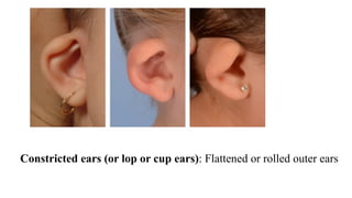 Ear Rim Rolled EAR ASSESSMENT | PDF