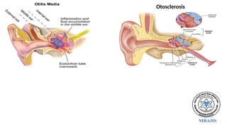 Otosclerosis
 