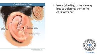 • Injury (bleeding) of auricle may
lead to deformed auricle i.e.
cauliflower ear
 