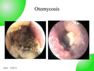 Otomycosis




Autor: 18.04.12
 